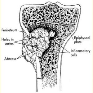 Understanding Osteomyelitis